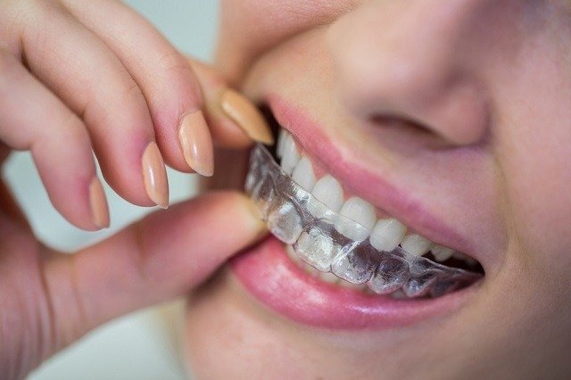 Do’s Don’ts of Invisalign