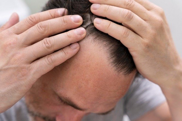 5 Effective Ways to Reclaim Your Hairline