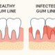 Protect Your Gums from Infection