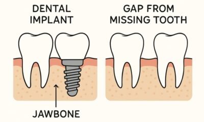 Benefits of Dental Implants