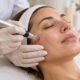 Microneedling at Anne Therese